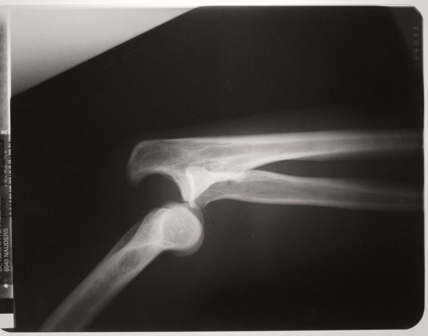 X-Ray With Dislocated Arm Joints