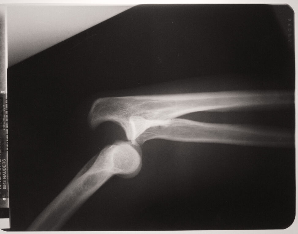 XRay With Dislocated Arm Joints Copyrightfree photo (by M. Vorel